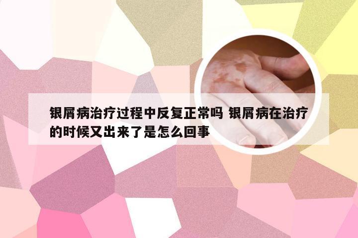 银屑病治疗过程中反复正常吗 银屑病在治疗的时候又出来了是怎么回事
