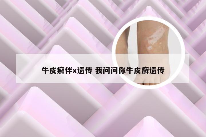 牛皮癣伴x遗传 我问问你牛皮癣遗传