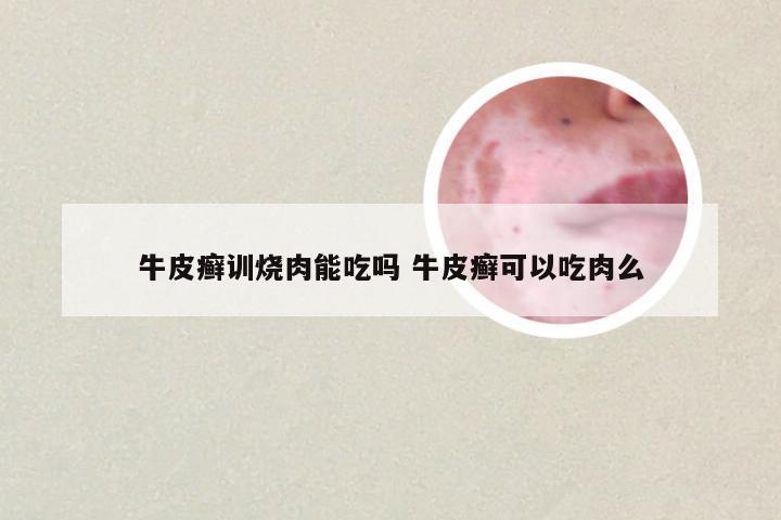 牛皮癣训烧肉能吃吗 牛皮癣可以吃肉么