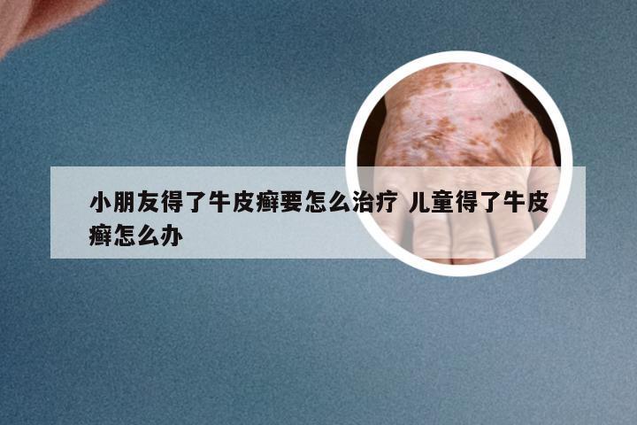 小朋友得了牛皮癣要怎么治疗 儿童得了牛皮癣怎么办