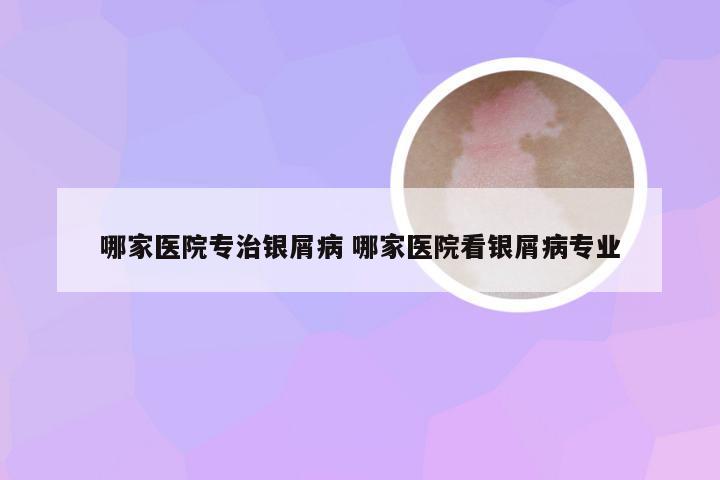 哪家医院专治银屑病 哪家医院看银屑病专业