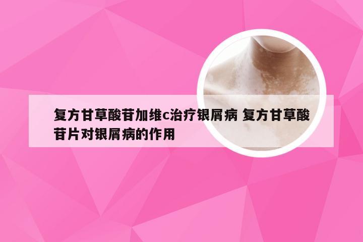 复方甘草酸苷加维c治疗银屑病 复方甘草酸苷片对银屑病的作用