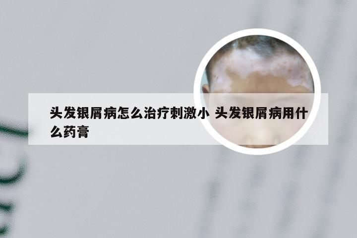 头发银屑病怎么治疗刺激小 头发银屑病用什么药膏