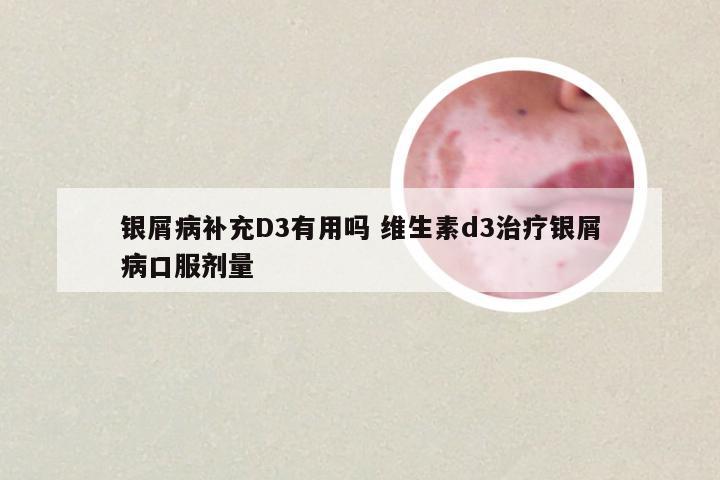 银屑病补充D3有用吗 维生素d3治疗银屑病口服剂量