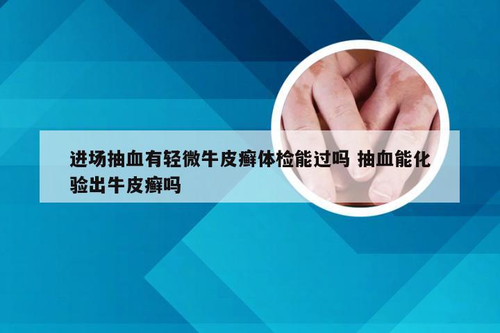 进场抽血有轻微牛皮癣体检能过吗 抽血能化验出牛皮癣吗