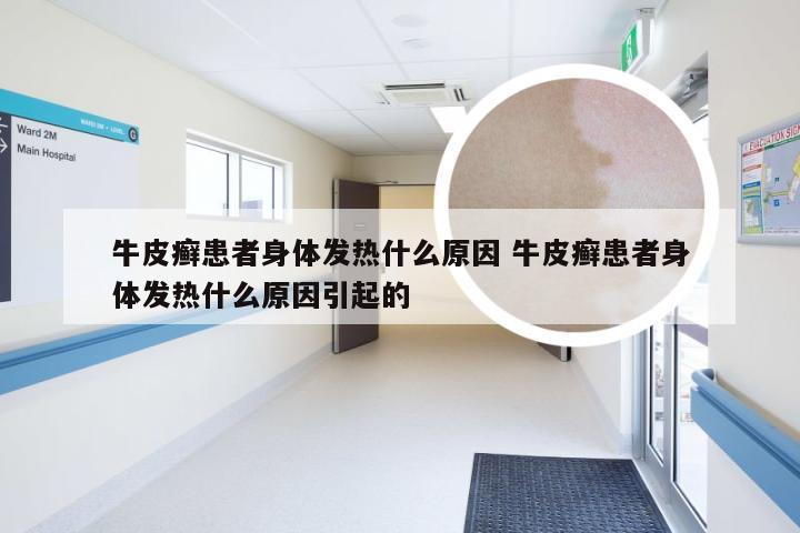 牛皮癣患者身体发热什么原因 牛皮癣患者身体发热什么原因引起的