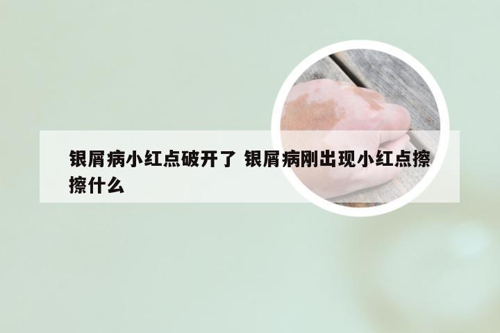 银屑病小红点破开了 银屑病刚出现小红点擦擦什么