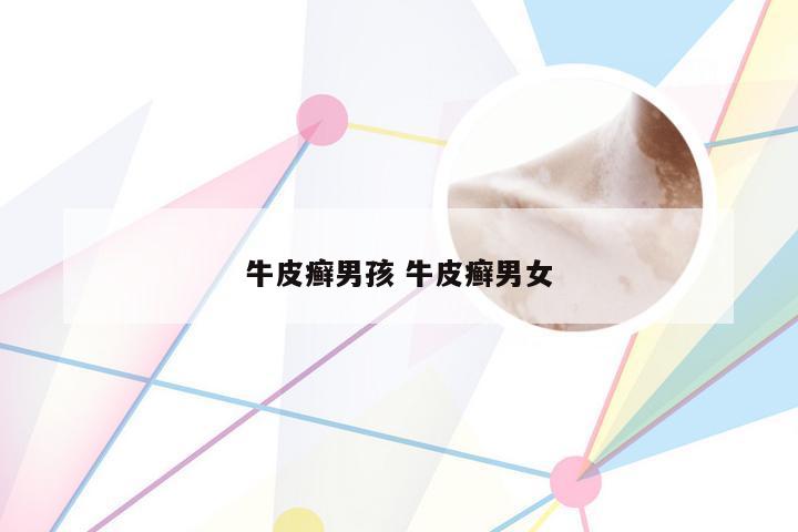 牛皮癣男孩 牛皮癣男女