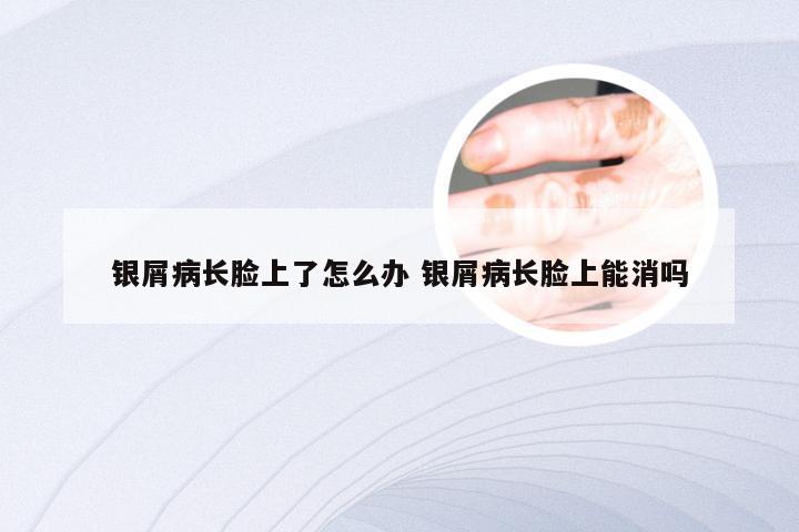 银屑病长脸上了怎么办 银屑病长脸上能消吗