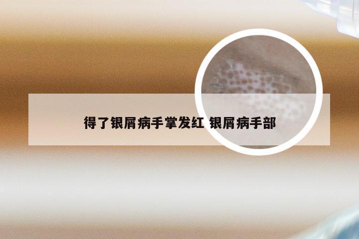 得了银屑病手掌发红 银屑病手部