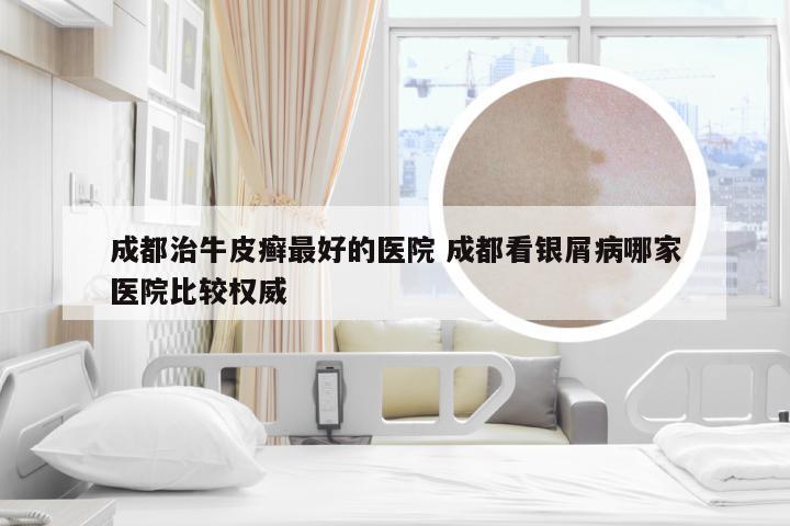 成都治牛皮癣最好的医院 成都看银屑病哪家医院比较权威