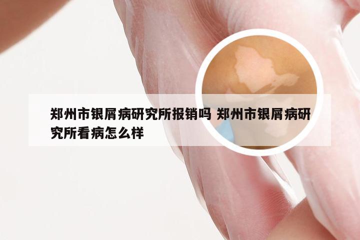 郑州市银屑病研究所报销吗 郑州市银屑病研究所看病怎么样