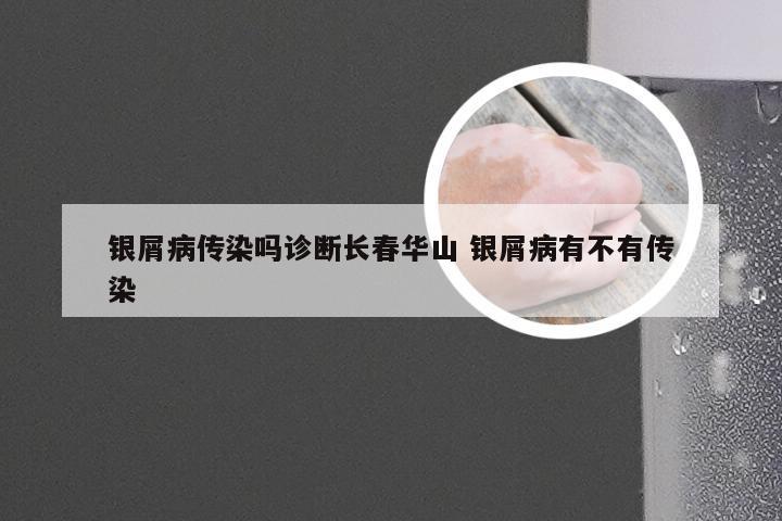 银屑病传染吗诊断长春华山 银屑病有不有传染