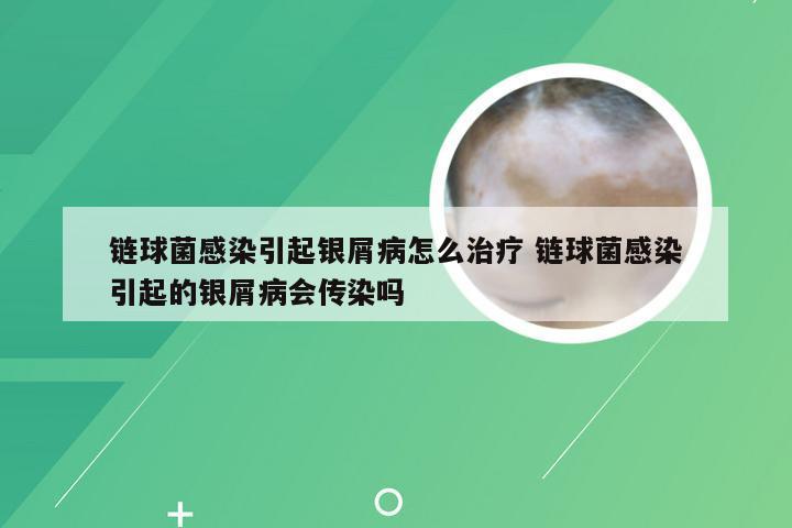 链球菌感染引起银屑病怎么治疗 链球菌感染引起的银屑病会传染吗