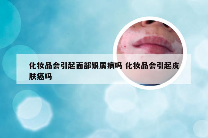 化妆品会引起面部银屑病吗 化妆品会引起皮肤癌吗