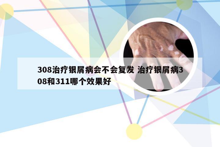 308治疗银屑病会不会复发 治疗银屑病308和311哪个效果好