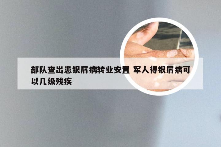 部队查出患银屑病转业安置 军人得银屑病可以几级残疾