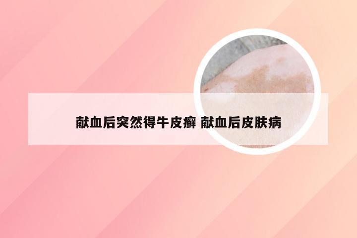 献血后突然得牛皮癣 献血后皮肤病