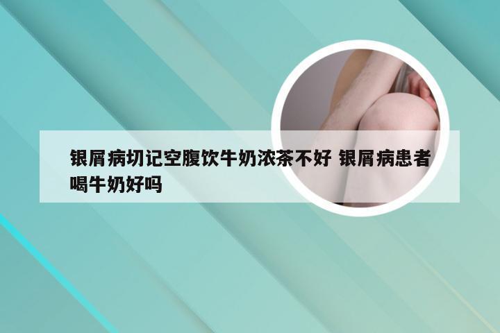 银屑病切记空腹饮牛奶浓茶不好 银屑病患者喝牛奶好吗