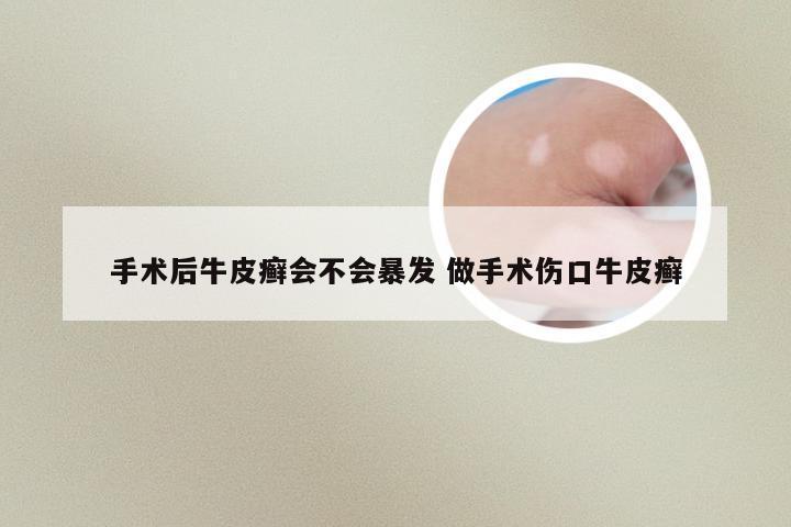手术后牛皮癣会不会暴发 做手术伤口牛皮癣