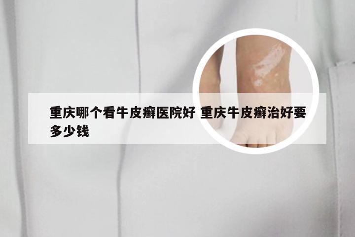 重庆哪个看牛皮癣医院好 重庆牛皮癣治好要多少钱