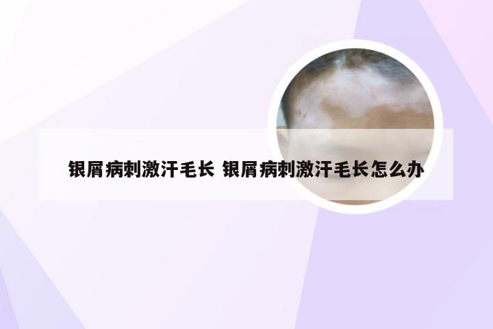 银屑病刺激汗毛长 银屑病刺激汗毛长怎么办
