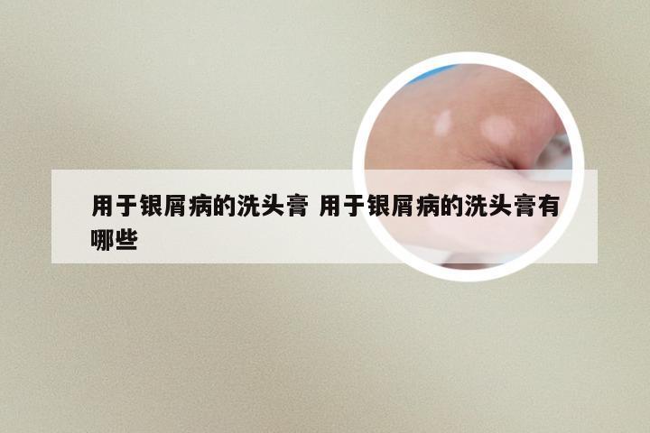 用于银屑病的洗头膏 用于银屑病的洗头膏有哪些