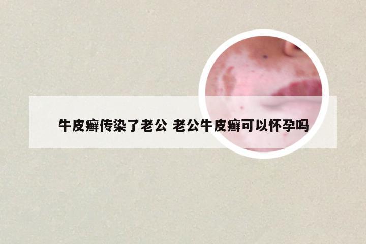 牛皮癣传染了老公 老公牛皮癣可以怀孕吗