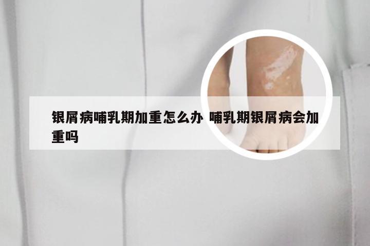 银屑病哺乳期加重怎么办 哺乳期银屑病会加重吗