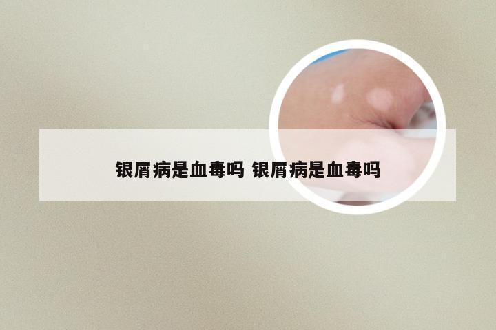银屑病是血毒吗 银屑病是血毒吗