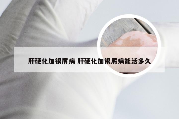 肝硬化加银屑病 肝硬化加银屑病能活多久
