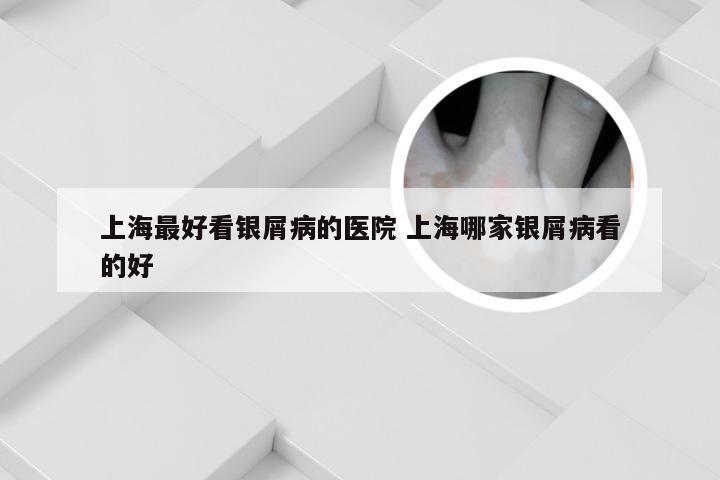 上海最好看银屑病的医院 上海哪家银屑病看的好