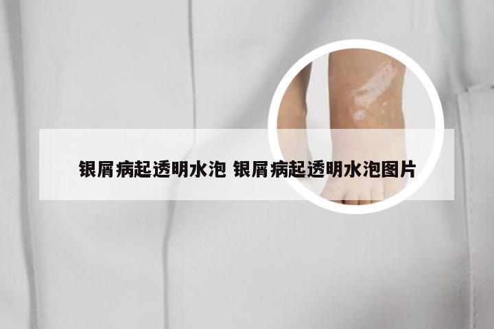 银屑病起透明水泡 银屑病起透明水泡图片