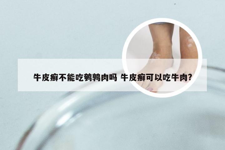 牛皮癣不能吃鹌鹑肉吗 牛皮癣可以吃牛肉?