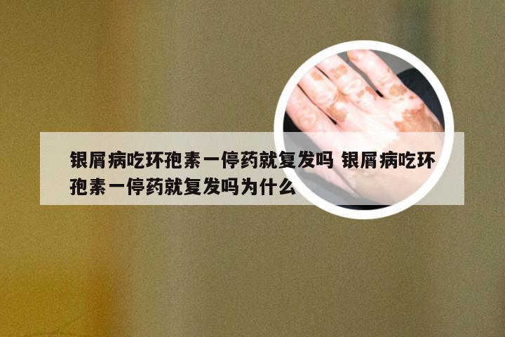 银屑病吃环孢素一停药就复发吗 银屑病吃环孢素一停药就复发吗为什么