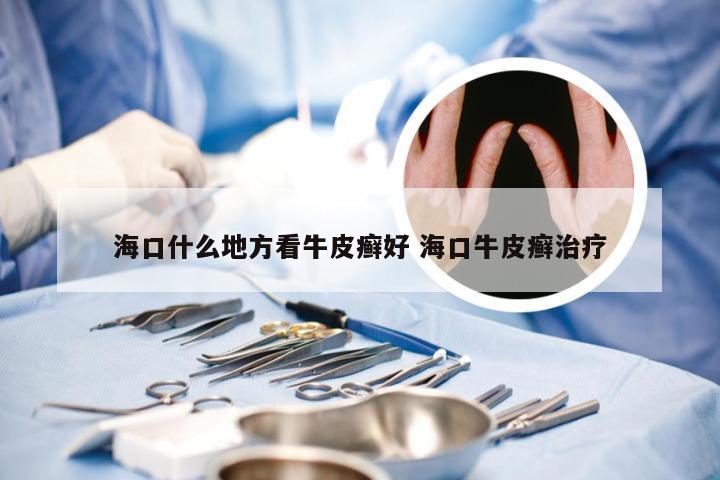 海口什么地方看牛皮癣好 海口牛皮癣治疗