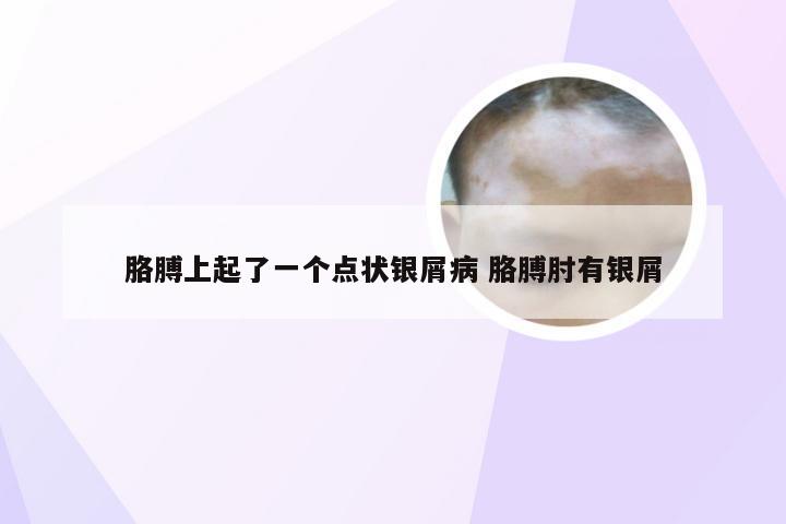 胳膊上起了一个点状银屑病 胳膊肘有银屑