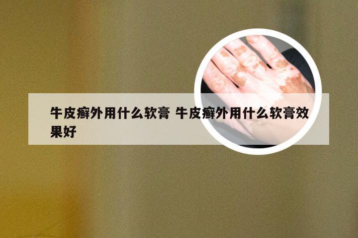 牛皮癣外用什么软膏 牛皮癣外用什么软膏效果好