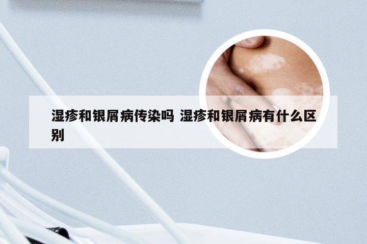 湿疹和银屑病传染吗 湿疹和银屑病有什么区别