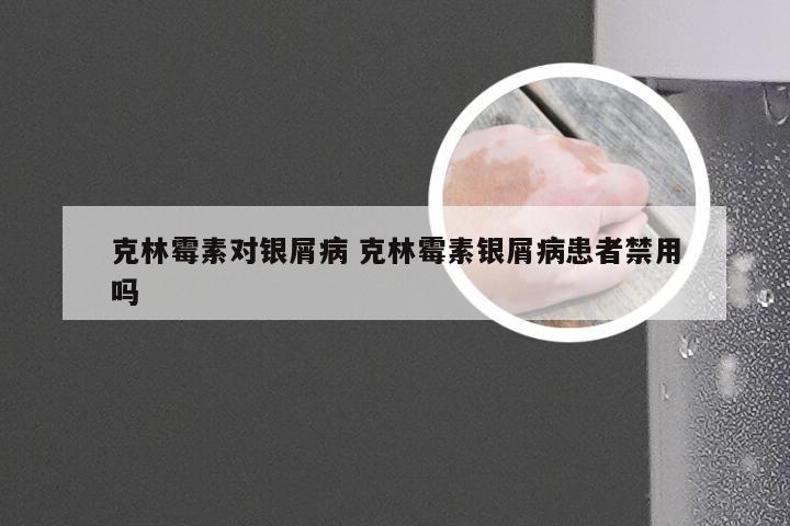 克林霉素对银屑病 克林霉素银屑病患者禁用吗