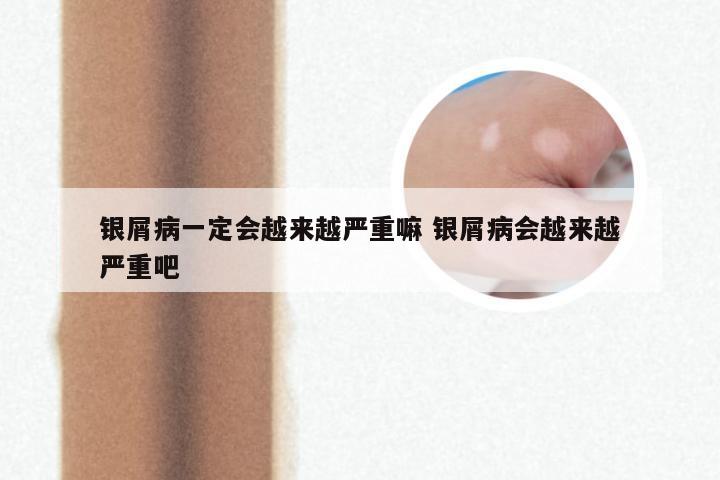 银屑病一定会越来越严重嘛 银屑病会越来越严重吧