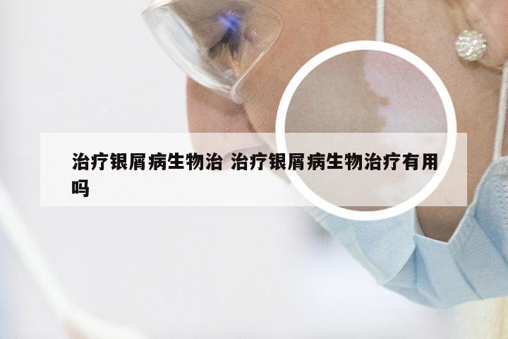 治疗银屑病生物治 治疗银屑病生物治疗有用吗