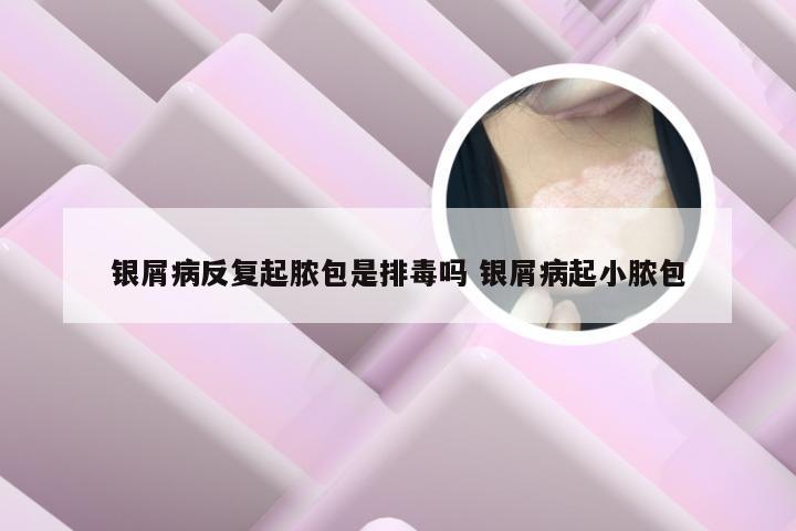银屑病反复起脓包是排毒吗 银屑病起小脓包