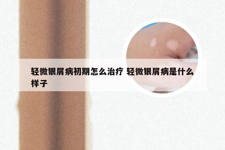 轻微银屑病初期怎么治疗 轻微银屑病是什么样子