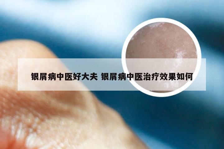 银屑病中医好大夫 银屑病中医治疗效果如何