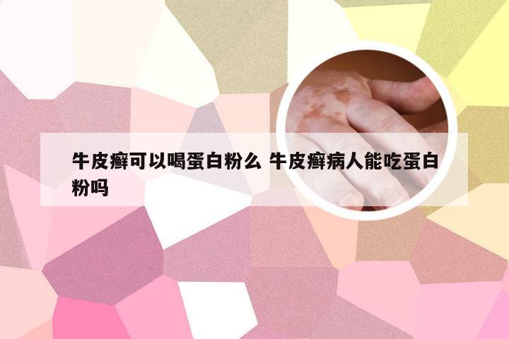 牛皮癣可以喝蛋白粉么 牛皮癣病人能吃蛋白粉吗
