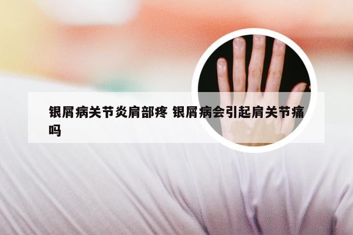 银屑病关节炎肩部疼 银屑病会引起肩关节痛吗