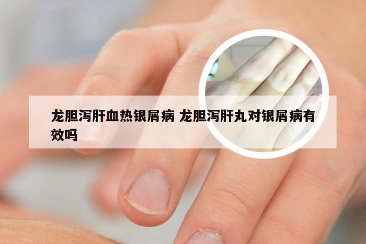 龙胆泻肝血热银屑病 龙胆泻肝丸对银屑病有效吗