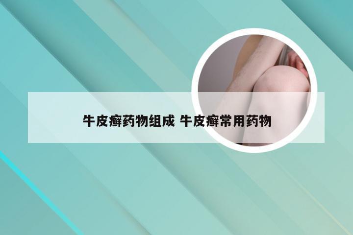 牛皮癣药物组成 牛皮癣常用药物