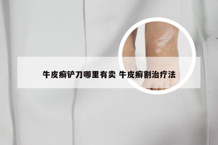 牛皮癣铲刀哪里有卖 牛皮癣割治疗法